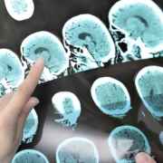 part of the brain alzheimer's affects