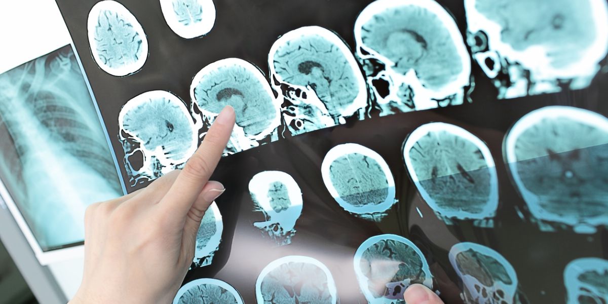 part of the brain alzheimer's affects