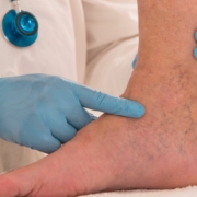 doctor showing when to worry about varicose veins